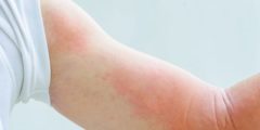 الطفح الجلدي: أسبابه، أعراضه وطرق علاجه