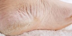 كيفية علاج جلد القدم السميك
