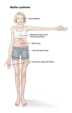 متلازمة مارفان: الأعراض، الأسباب والعلاج